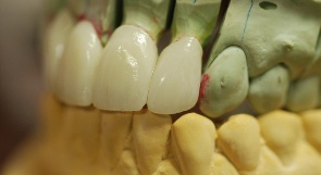 Porcelain fused-to-metal 