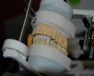 Veneer